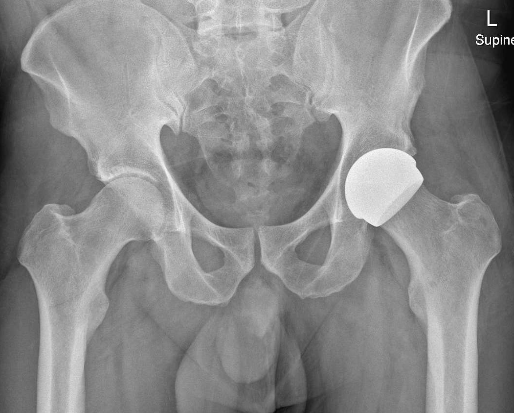 Postoperative X-ray showing a ceramic hip resurfacing